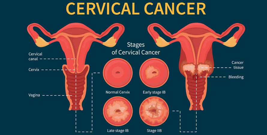 Stages Of Cervical Cancer