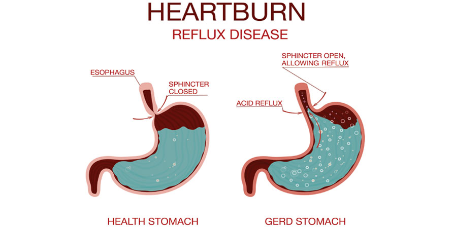 Cause Heartburn