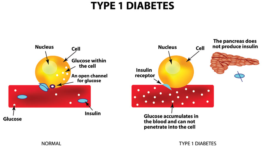 Types Of Diabetes
