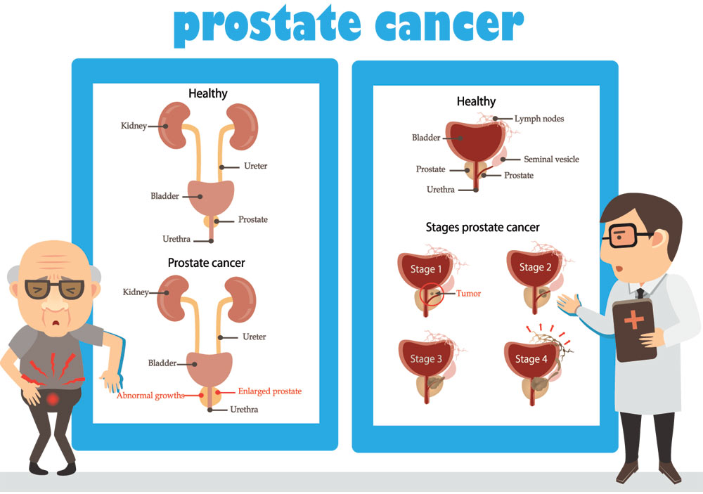 Prostate Cancer Develop