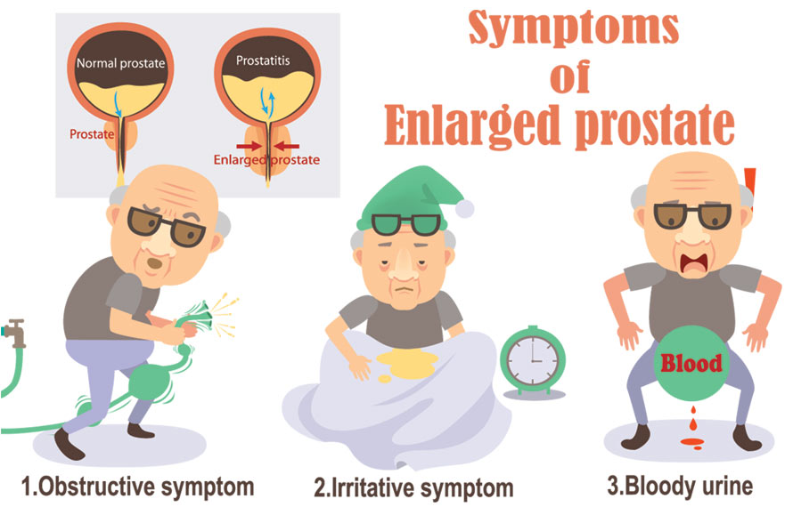 Causing Prostate Enlargement