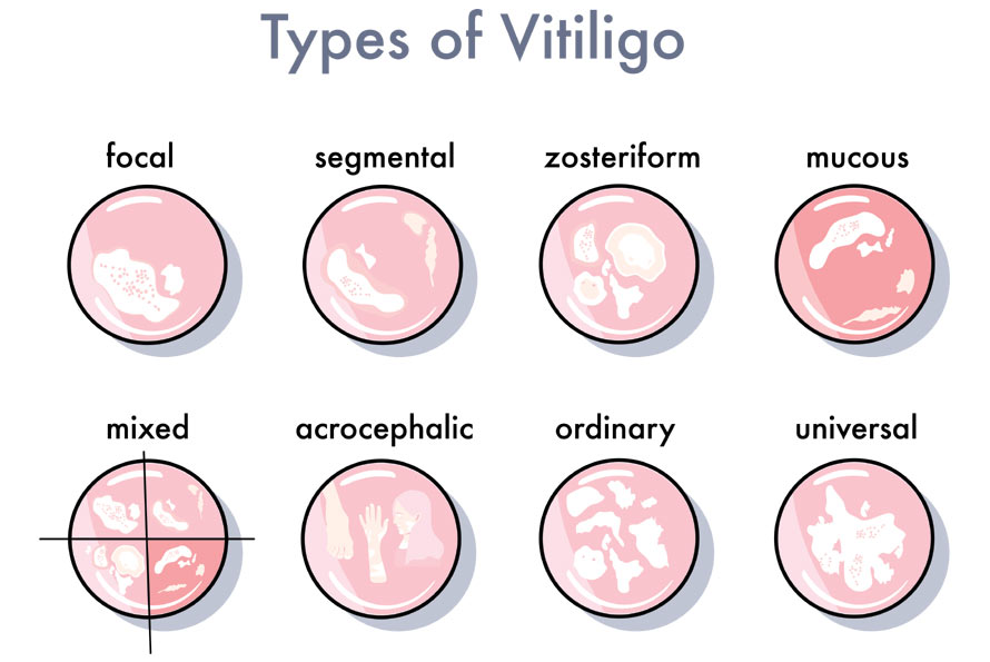 Types Of Vitiligo