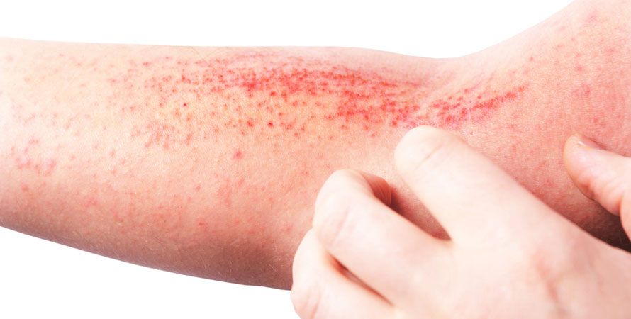 Contact dermatitis