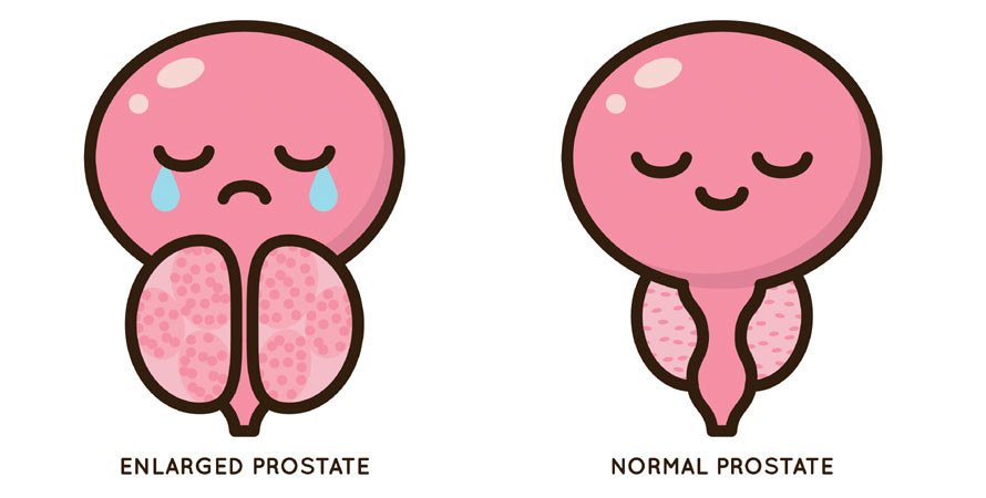 Causes Of Enlarged Bladder