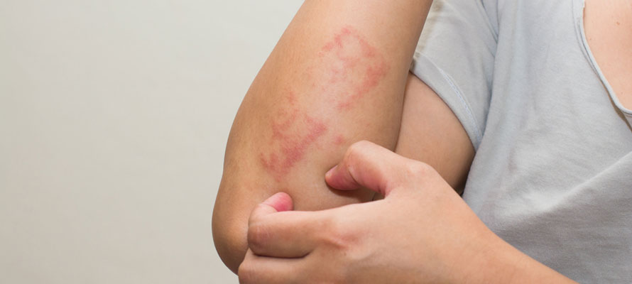 Eczema an Autoimmune Disease