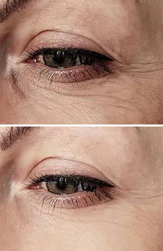before-after