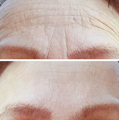 head-before-after