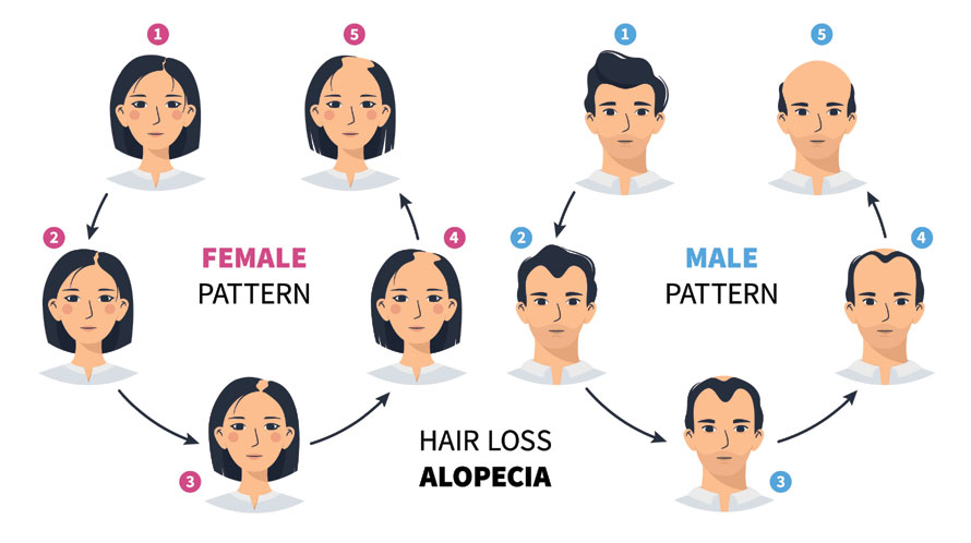 Hair Loss Stages