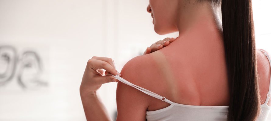 hells-itch-sunburn