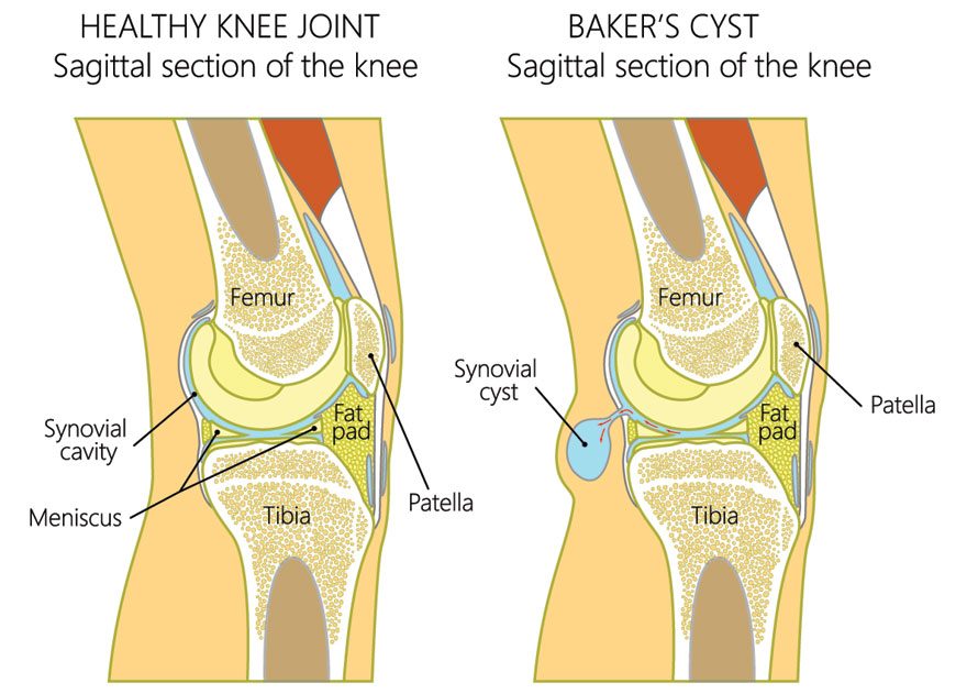 Bakers cyst