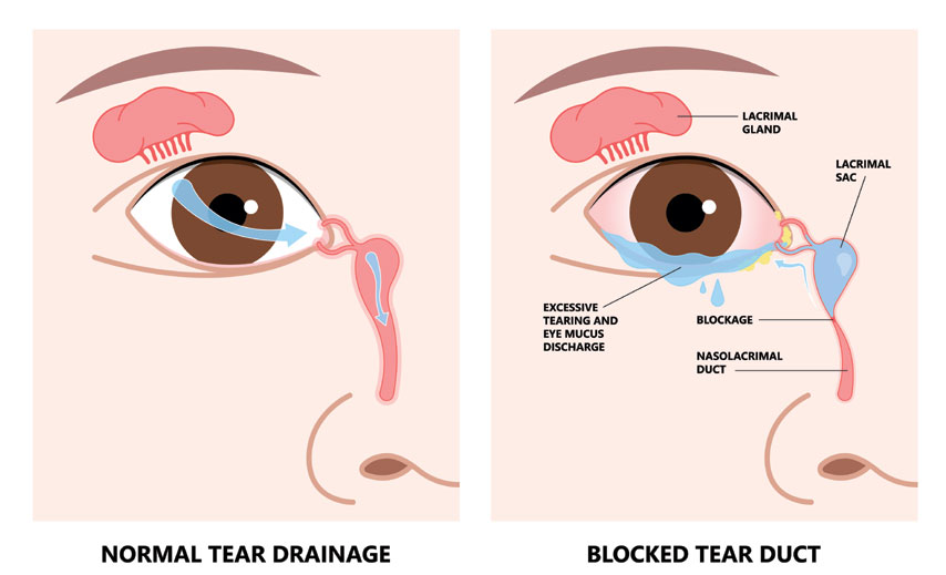 Blocked tear ducts