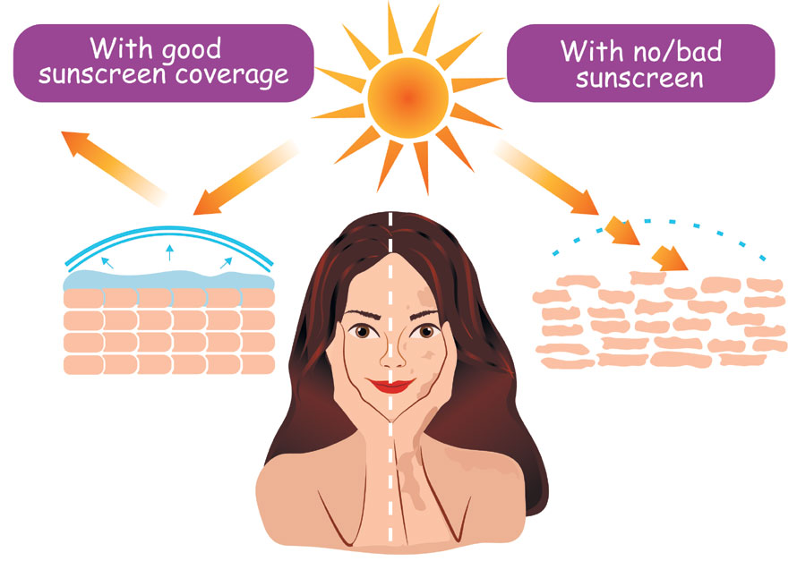 Sun Poisoning Causes