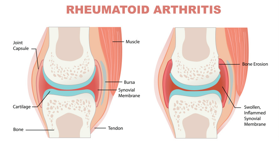 illustration showing joint inflammation in rheumatoid arthritis causing fatigue and joint pain
