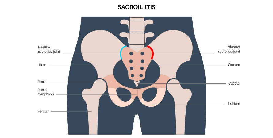 Sacroiliac Joint Pain – Key Symptoms and Affected Areas