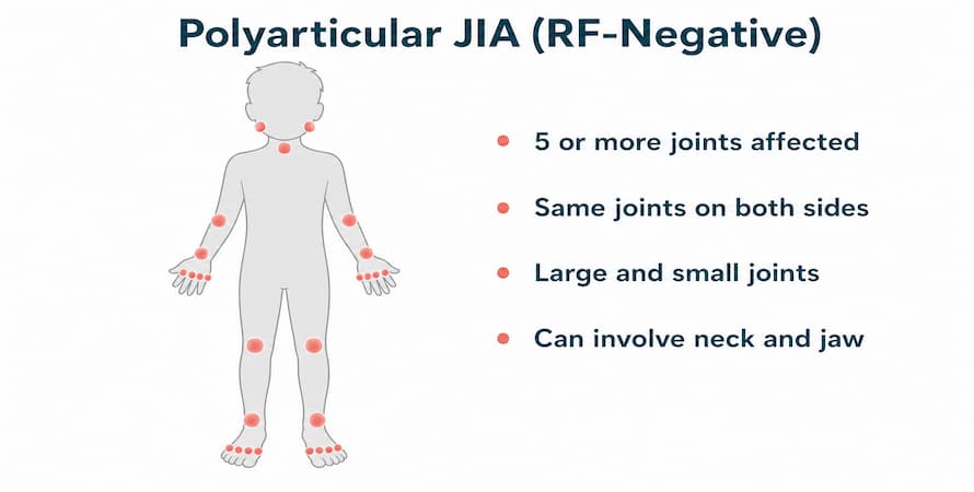 Polyarticular JIA (RF-Negative)