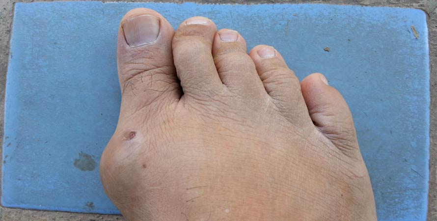 Causes of Gout