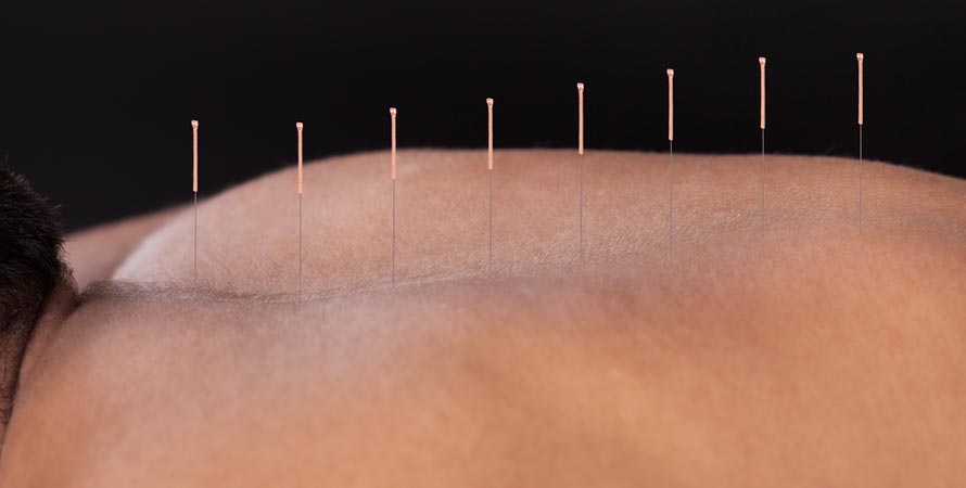 acupuncture