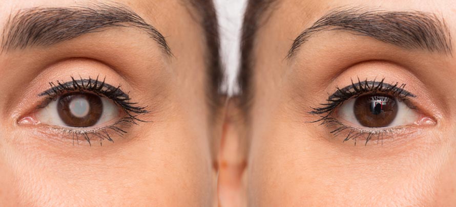 Cataracts and Diabetes