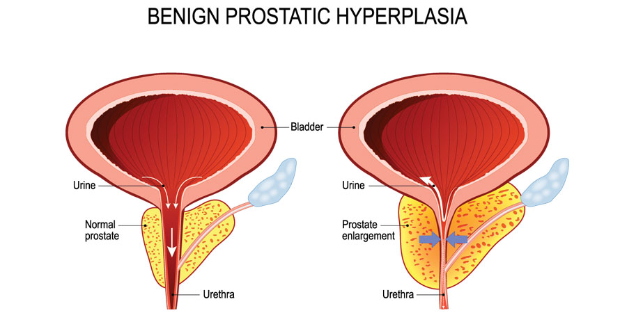 causes of enlarged prostate
