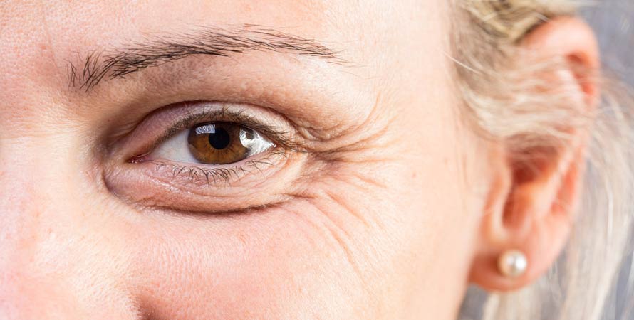Eye Wrinkles