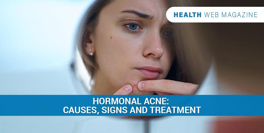Hormonal Acne