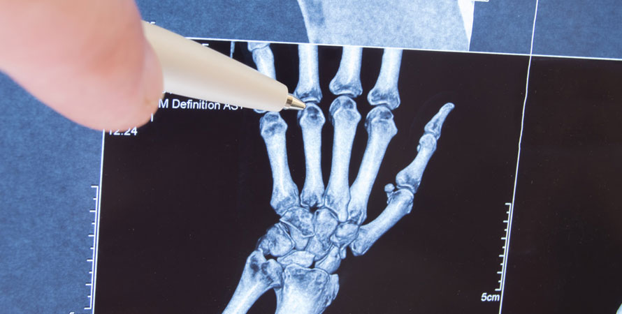 recognize-rheumatoid-arthritis