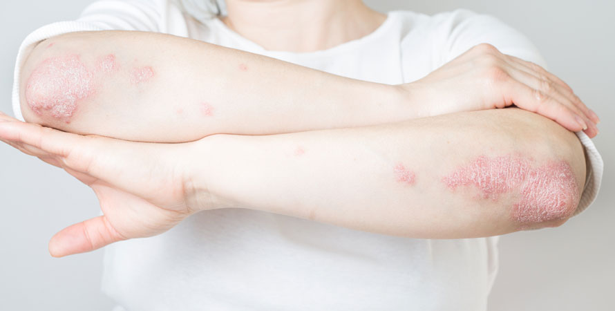 Red, Inflamed Skin
